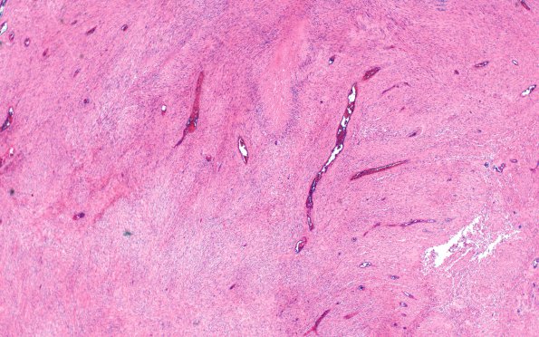 19A Gliosarcoma (Case 19) H&E 4X