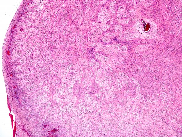 1A1 Gliosarcoma (Case 1) Area B 4X H&E.jpg