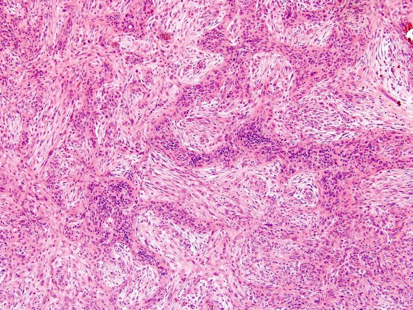 1A2 Gliosarcoma (Case 1) Area B H&E 10X