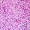 1A3 Gliosarcoma (Case 1) H&E 1.jpg