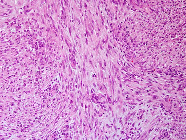 1A3 Gliosarcoma (Case 1) H&E 1.jpg