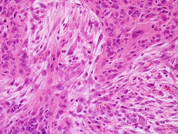 1A4 Gliosarcoma (Case 1) Area B H&E 40X 6.jpg