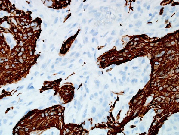 1B3 Gliosarcoma (Case 1) Area B GFAP 40X1.jpg