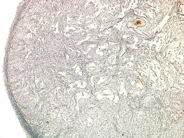 1C1 Gliosarcoma (Case 1) Area B 4X Retic.jpg