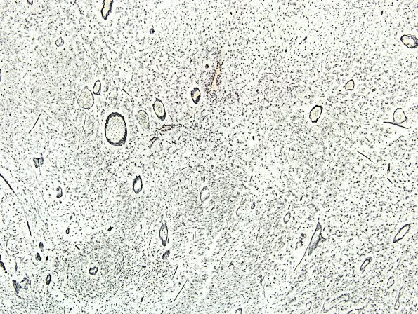 1C4 Gliosarcoma (Case 1) Pnet Area Retic 10X