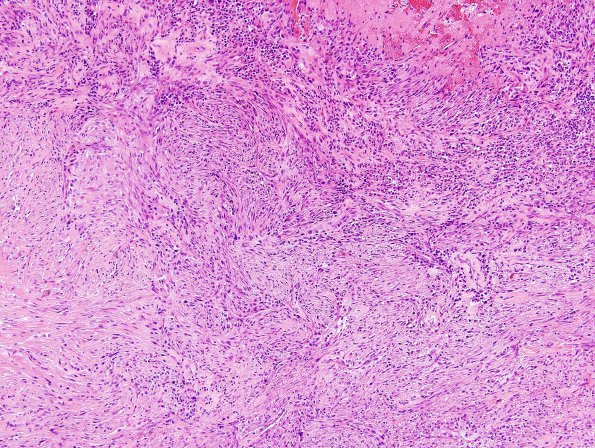 20A1 Gliosarcoma (Case 20) H&E 2.jpg