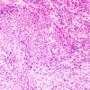 20A2 Gliosarcoma (Case 20) H&E 3.jpg