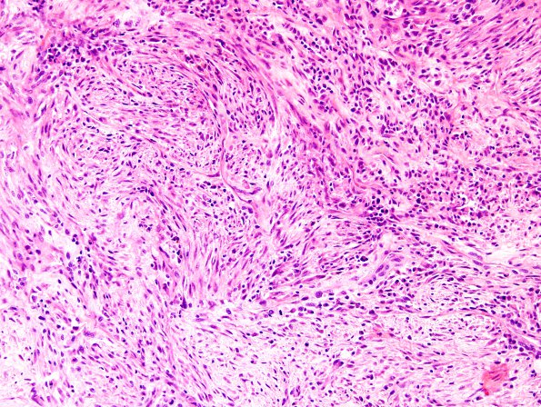 20A2 Gliosarcoma (Case 20) H&E 3.jpg