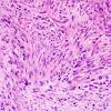 20A3 Gliosarcoma (Case 20) H&E 1.jpg