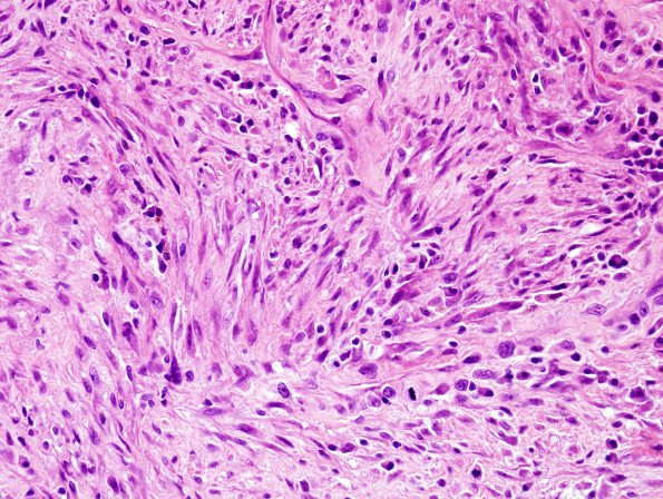 20A3 Gliosarcoma (Case 20) H&E 1.jpg