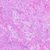 21A Gliosarcoma, adenoid (Case 21) H&E 14