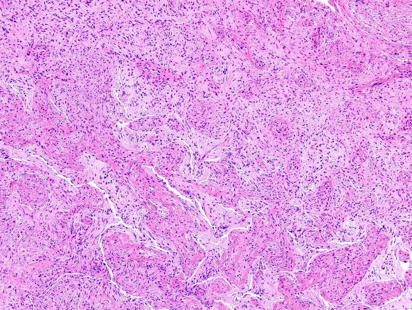 21A Gliosarcoma, adenoid (Case 21) H&E 14