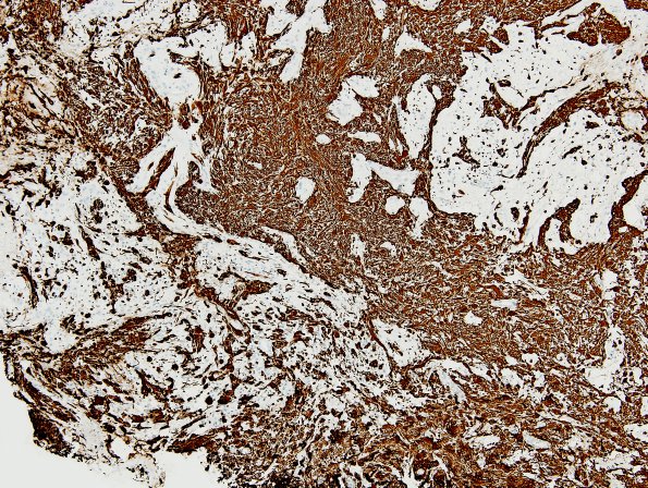 21B2 Gliosarcoma, adenoid (Case 21) GFAP 5