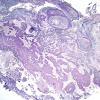 21C1 Gliosarcoma, adenoid (Case 21) Retic 7