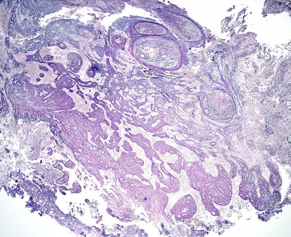 21C1 Gliosarcoma, adenoid (Case 21) Retic 7