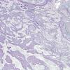 21C2 Gliosarcoma, adenoid (Case 21) Retic 3