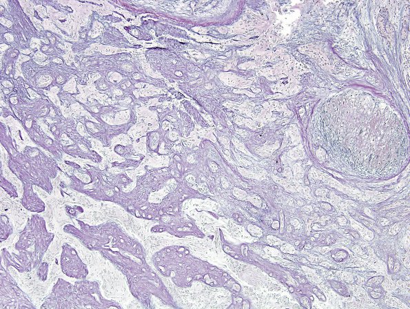 21C2 Gliosarcoma, adenoid (Case 21) Retic 3