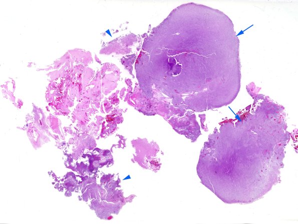 22A1 Gliosarcoma (Case 22) H&E WM copy