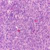 22A10 Gliosarcoma (Case 22) H&E 20X 3 (2)