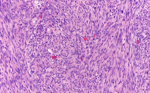 22A10 Gliosarcoma (Case 22) H&E 20X 3 (2)