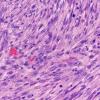 22A11 Gliosarcoma (Case 22) H&E 40X 2