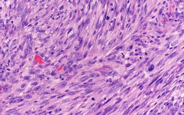 22A11 Gliosarcoma (Case 22) H&E 40X 2