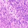 22A12 Gliosarcoma (Case 22) H&E 40X