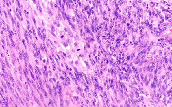 22A12 Gliosarcoma (Case 22) H&E 40X