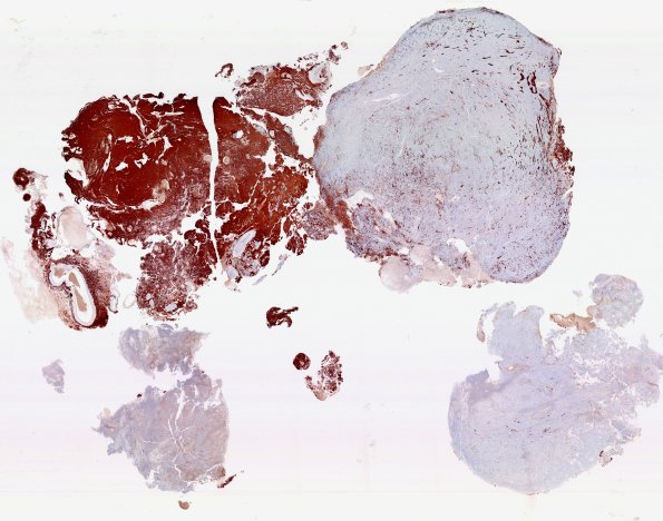 22A2 Gliosarcoma (Case 22) GFAP WM