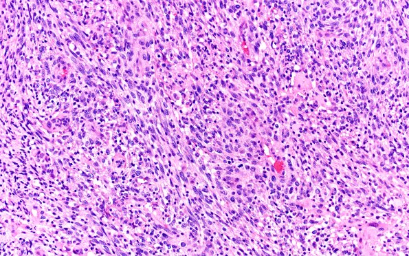 22A4 Gliosarcoma (Case 22) H&E 20x 4