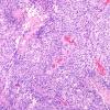 22A5 Gliosarcoma (Case 22) H&E 10X 3