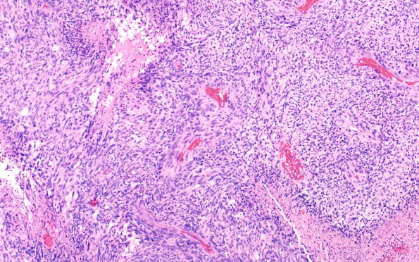 22A5 Gliosarcoma (Case 22) H&E 10X 3