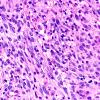 22A6 Gliosarcoma (Case 22) H&E 40x 4