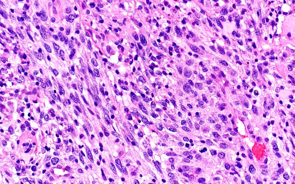 22A6 Gliosarcoma (Case 22) H&E 40x 4