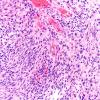 22A7 Gliosarcoma (Case 22) H&E 20x 4