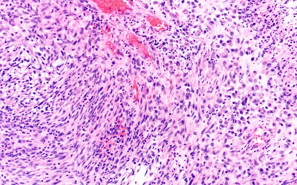 22A7 Gliosarcoma (Case 22) H&E 20x 4