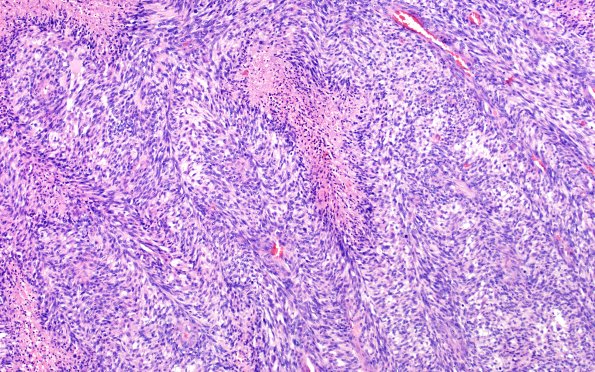 22A8 Gliosarcoma (Case 22) H&E 10x 2