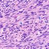 22A9 Gliosarcoma (Case 22) H&E 20x 7 copy