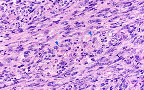 22A9 Gliosarcoma (Case 22) H&E 20x 7 copy