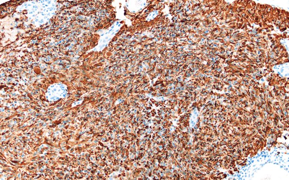 22B1 Gliosarcoma (Case 22) GFAP 20X 2