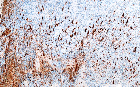 22B5 Gliosarcoma (Case 22) GFAP 10X 3