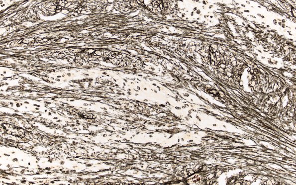 22C7 Gliosarcoma (Case 22) Retic 20X 2 match