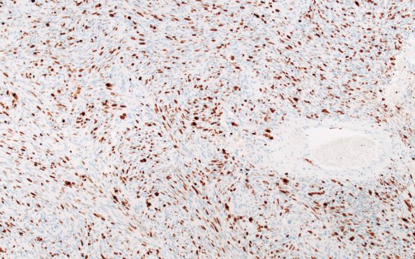 22D3 Gliosarcoma (Case 22) KI67 10x