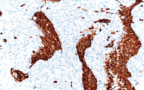 22D4 Gliosarcoma (Case 22) GFAP 20X 2 (2)