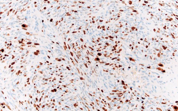 22D6 Gliosarcoma (Case 22) KI67 20x (2)