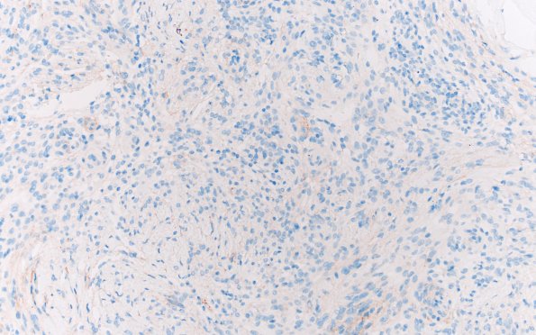 22F Gliosarcoma (Case 22) EMA 20X 1