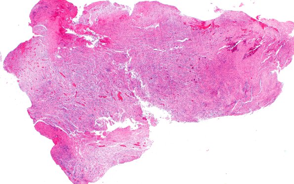 23A1 Gliosarcoma (Case 23) H&E 2X