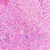 23A10 Gliosarcoma (Case 23) H&E Area B 20X 1 copy