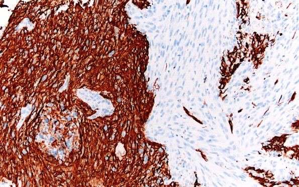 23A11 Gliosarcoma (Case 23) GFAP Area B 20X 1
