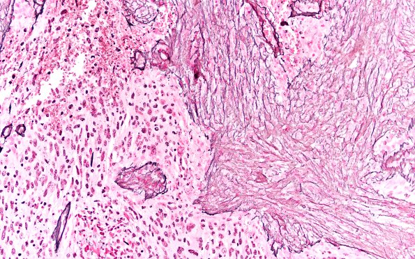 23A12 Gliosarcoma (Case 23) Retic Area B 20X 1